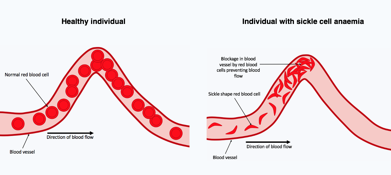 Microscopic illustration of sickle-shaped red blood cells in a blood vessel