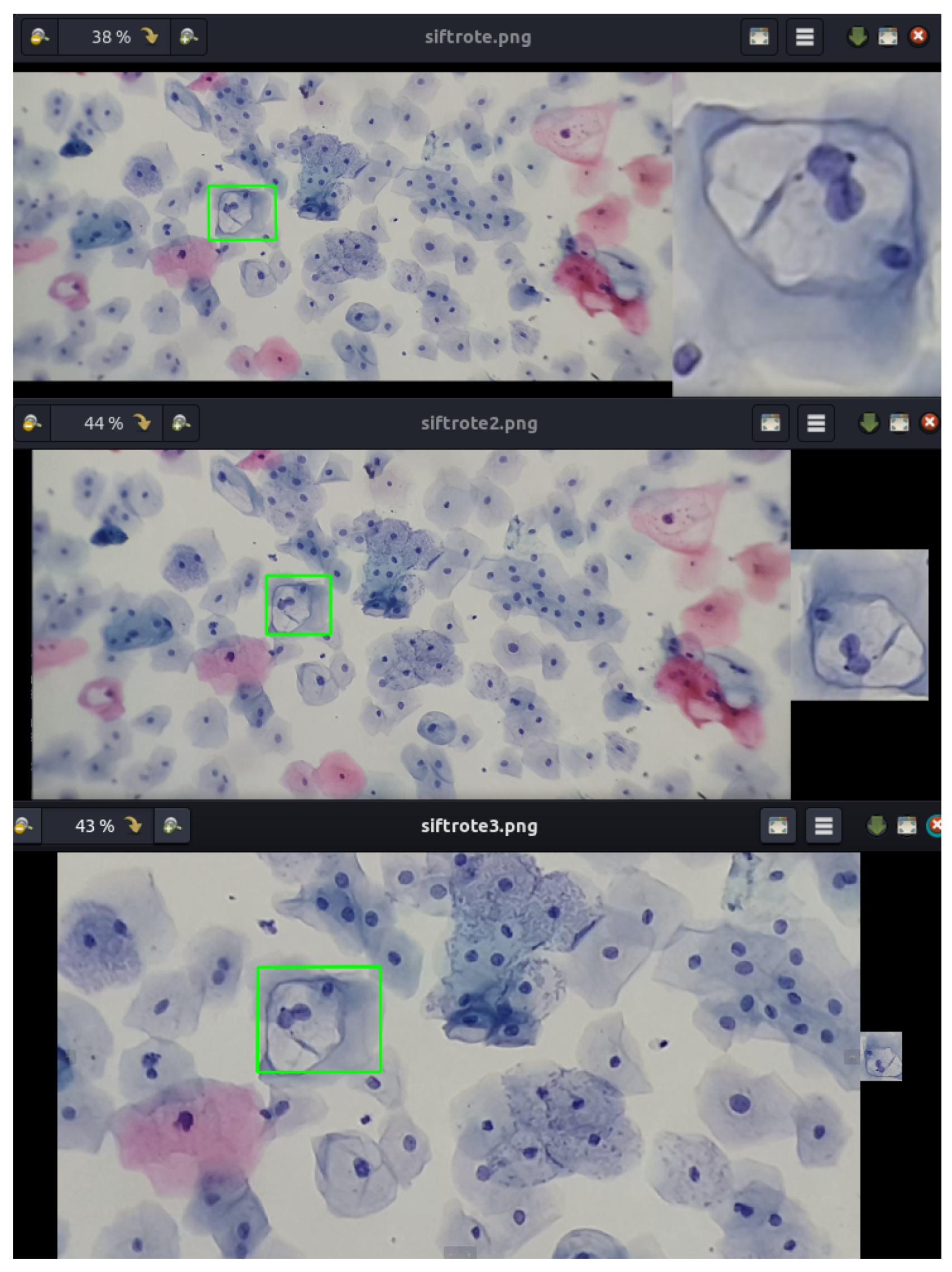 Microscopic image of cervical cytology cells with koilocytes indicating HPV change